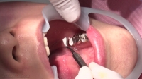 あおい(24)【歯科治療映像】フルメタルクライン装着までの衝撃の4日間！