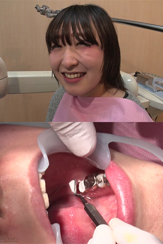 あおい(24)【歯科治療映像】フルメタルクライン装着までの衝撃の4日間！