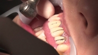 フェチ：あおい(24)【歯科治療映像】前代未聞の上前歯3本連続フルメタルクラウンへ始動開始！