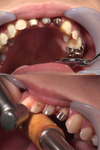 あおい(24)【歯科治療映像】前代未聞の上前歯3本連続フルメタルクラウンへ始動開始！