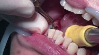 るみ(34)【歯科治療映像】6年以上放置したビッチリこびり付いた歯石と虫歯3本発見！