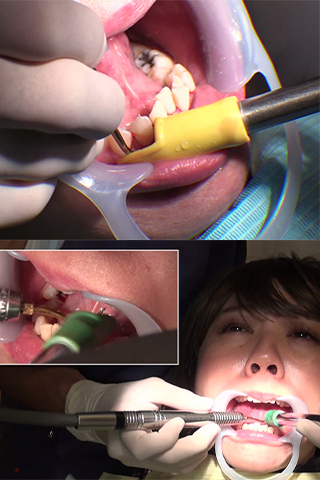 るみ(34)【歯科治療映像】6年以上放置したビッチリこびり付いた歯石と虫歯3本発見！