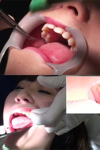 御坂美琴(21)【歯科治療映像】インレー同時3本装着ついに完成！