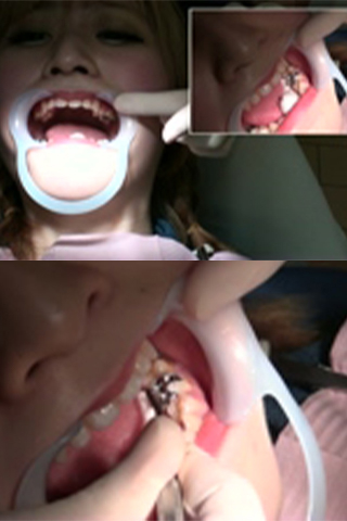 御坂美琴(21)【歯科治療映像】長岐に渡った虫歯治療もついにインレー装着にて完結！