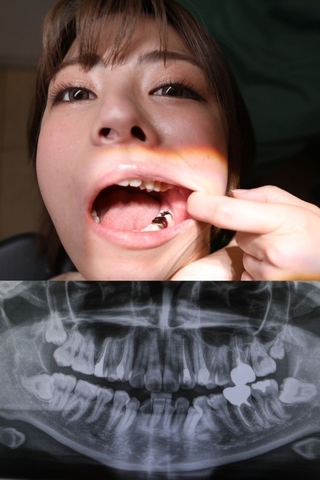 歯が染みる～！？歯医者を薦めたら急遽治療決定！！岬あずさ（23）の右下7番う蝕治療＆歯肉炎象牙質過敏症治療