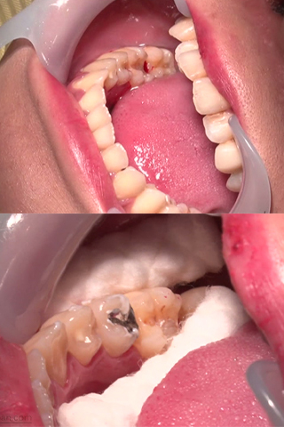 めぐみ(25)【歯科治療映像】３連続インレー装着と前歯6本の掘削映像！