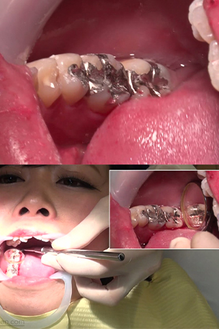 めぐみ(25)【歯科治療映像】３連続インレー装着と前歯6本の掘削映像！