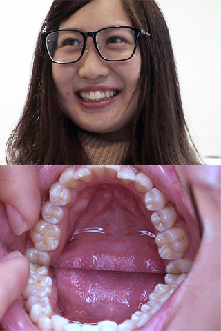 安田ななは(20)【歯科治療映像】約10年ぶりの治療に麻酔無しで挑むが･･･まさかのお蔵入りか！？