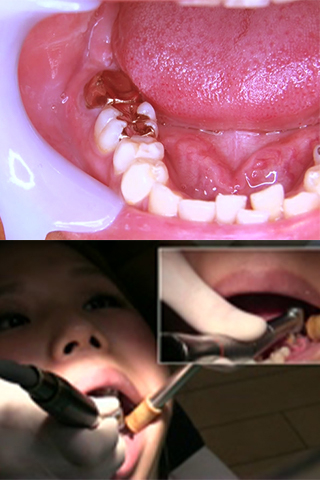 かずみ(25)【歯科治療映像】銀歯左右下6番を麻酔無し治療！母は強し！！