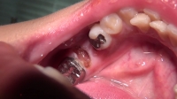 フェチ：かずみ(25)【歯科治療映像】産後やっとレントゲン！予想以上の崩壊歯に治療方針変更か!?