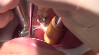 フェチ：かずみ(25)【歯科治療映像】恐ろしく長いメタルコアの出現！そしてインレー装着映像も収録！！