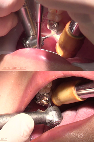 かずみ(25)【歯科治療映像】恐ろしく長いメタルコアの出現！そしてインレー装着映像も収録！！