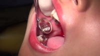 フェチ：かずみ(25)【歯科治療映像】フルメタルクラウン装着で長きに亘る治療に決着つけます！