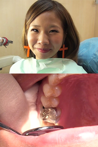 かずみ(25)【歯科治療映像】フルメタルクラウン装着で長きに亘る治療に決着つけます！