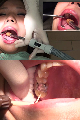 かずみ(25)【歯科治療映像】フルメタルクラウン装着で長きに亘る治療に決着つけます！