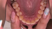山村茜(29)【歯科治療映像】左下6・7番インレー装着！美女が４年半ぶりに歯医者さんへ！