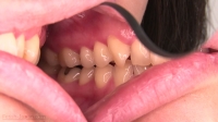 中島京子(35)【歯科治療映像】歯茎からの出血に歯石除去&顎関節症対策でマウスピース作製！