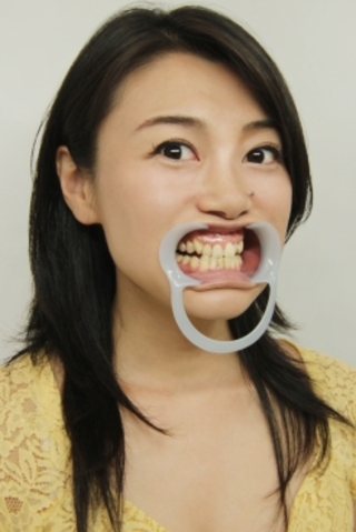 中島京子(35)【歯科治療映像】歯茎からの出血に歯石除去&顎関節症対策でマウスピース作製！
