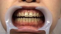 フェチ：伊達麻里子(28)【歯科治療映像】7～8年ぶりの歯医者さんで左上下5番の2本がインレーに!!