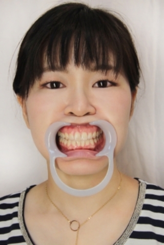 伊達麻里子(28)【歯科治療映像】7～8年ぶりの歯医者さんで左上下5番の2本がインレーに!!