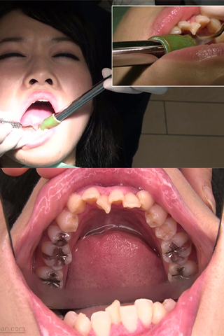 ゆき(24)【歯科治療映像】歯並び悪し！その裏に隠された銀歯9本と歯石除去！！
