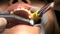 フェチ：いずみ(26)【歯科治療映像】只今銀歯６本所有！さらに治療で増量決定！