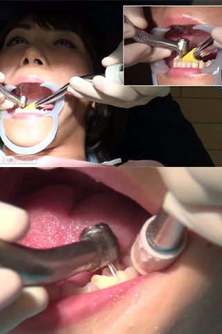 いずみ(26)【歯科治療映像】只今銀歯６本所有！さらに治療で増量決定！