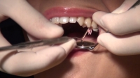 フェチ：いずみ(26)【歯科治療映像】一気に７本治療中！銀歯装着に向けて準備万全！！