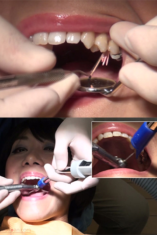 いずみ(26)【歯科治療映像】一気に７本治療中！銀歯装着に向けて準備万全！！