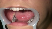 いずみ(26)【歯科治療映像】ついにファイナル！銀歯12本の絶景をご堪能下さい！！