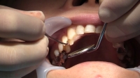 ゆうこ(29)【歯科治療映像】右上4･5番に2次カリエス発見！隣り合う右上3番も虫歯治療へ！！