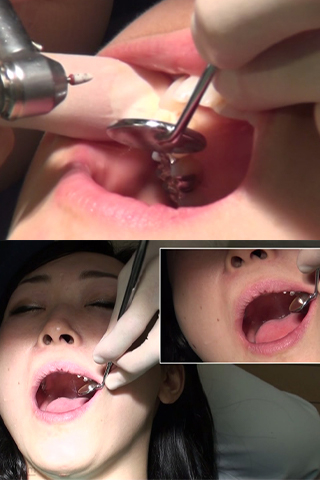 ゆうこ(29)【歯科治療映像】ラストスパートへGO！右上4･5番,左上4番を仮詰＆セラミック色合せ！