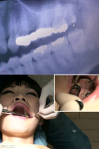 【緊急抜歯治療映像】奥歯がズキズキ！眠れないぐらいの痛みで.....ゆき25歳