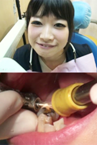 【根管治療映像】放置しすぎた虫歯には神経を搔き出すしか手立てはなかった！.....ゆき25歳