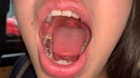 【虫歯治療5日目】『気になる前歯3箇所の虫歯掘削！！穴だらけの女、永野楓果(25)』に嬉しいサプライズ1箇所