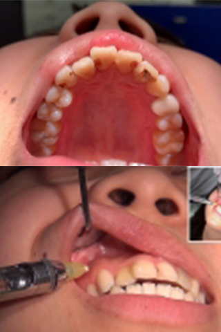 【虫歯治療5日目】『気になる前歯3箇所の虫歯掘削！！穴だらけの女、永野楓果(25)』に嬉しいサプライズ1箇所