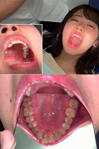 【永野楓果(25)治療4日目】初めて銀歯を入れた夜～左上奥歯3箇所虫歯治療～締めは大好物のラーメンで…