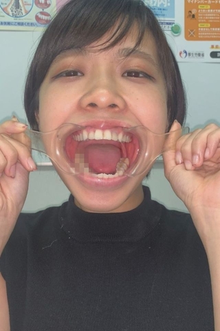 【これで見納め‼銀歯アイドル♡】永野楓果ちゃんの4連銀歯の行方…⁉歯フェチラボで2回も歳を重ねたクランケの完結編